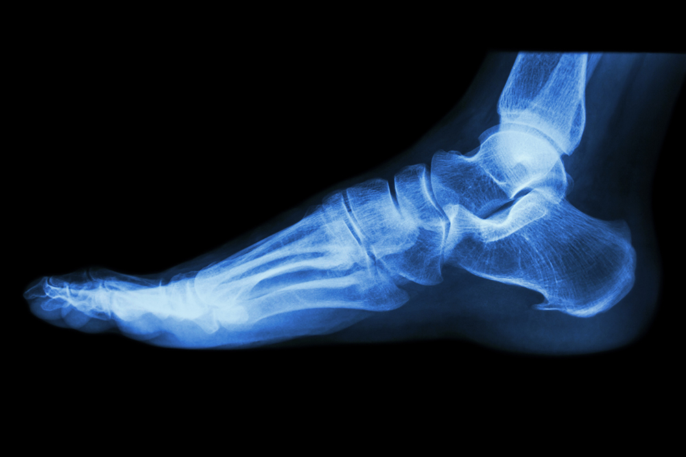 Foot X-Ray